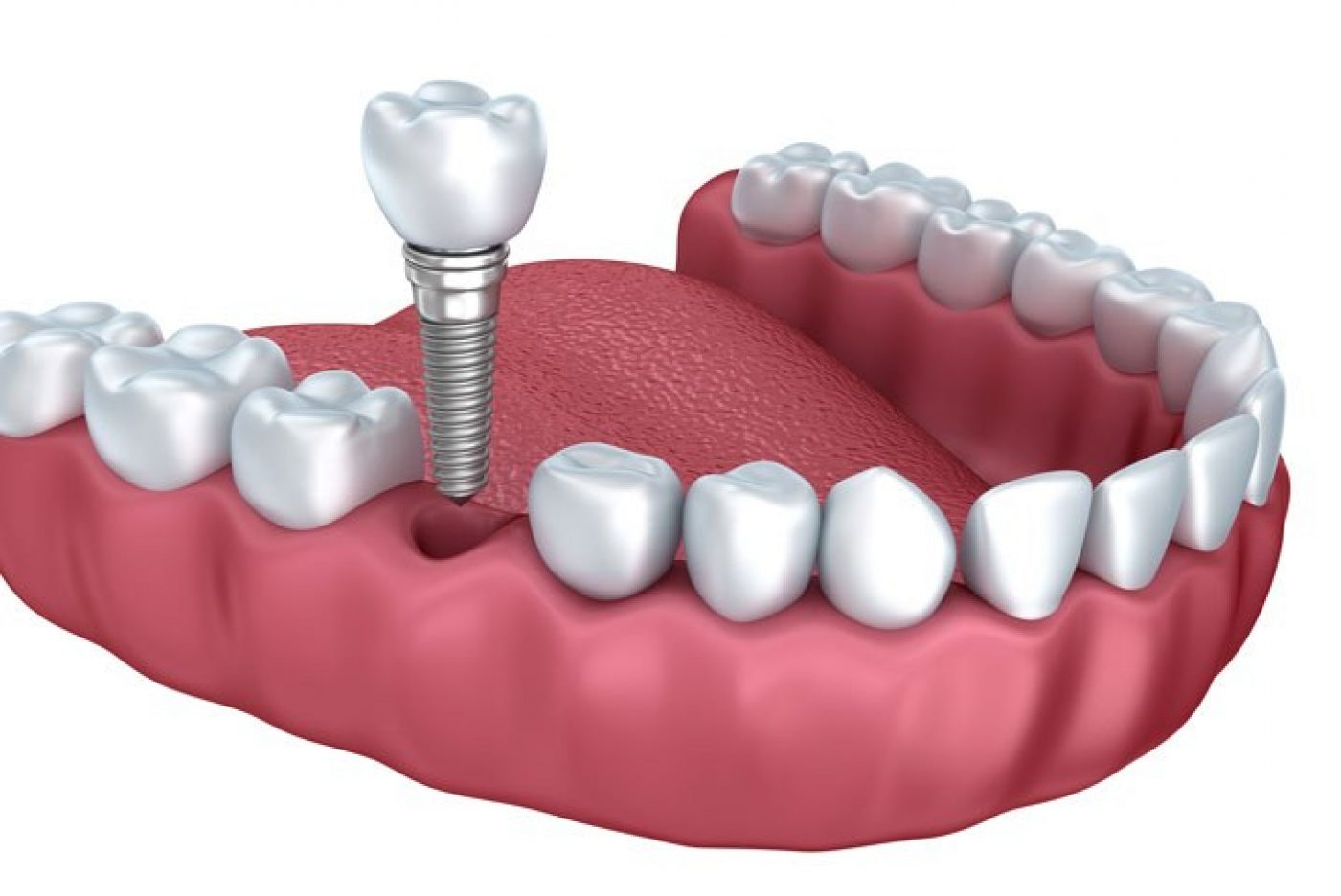 Dental Implants at Hereford Dental & Implant Clinic