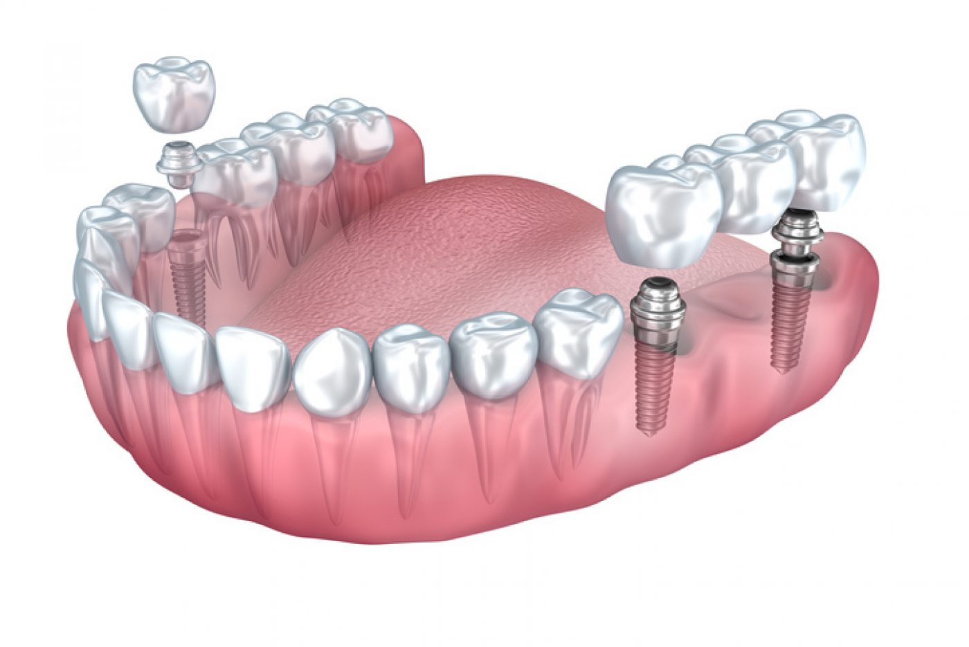 Sheffield-implant-bridge.jpg?mtime=20180307010738